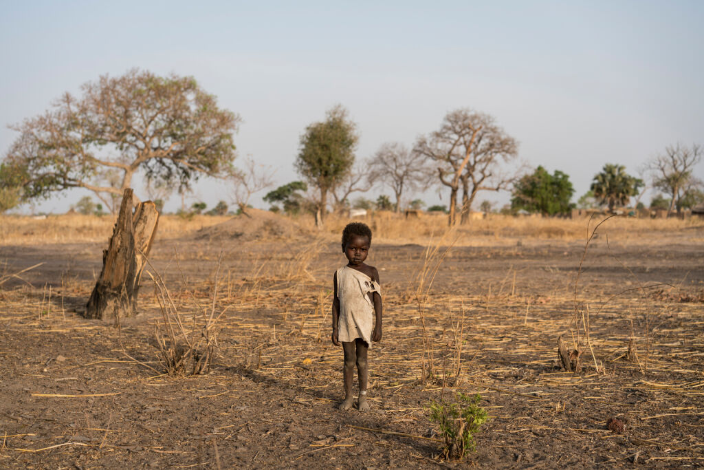 Eteläsudanilaisen Gielin nilkassa oleva valkoinen ranneke on merkki siitä, että hän on saanut apua aliravitsemukseen. Kuva: © UNICEF/UN056591/Knowles-Coursin