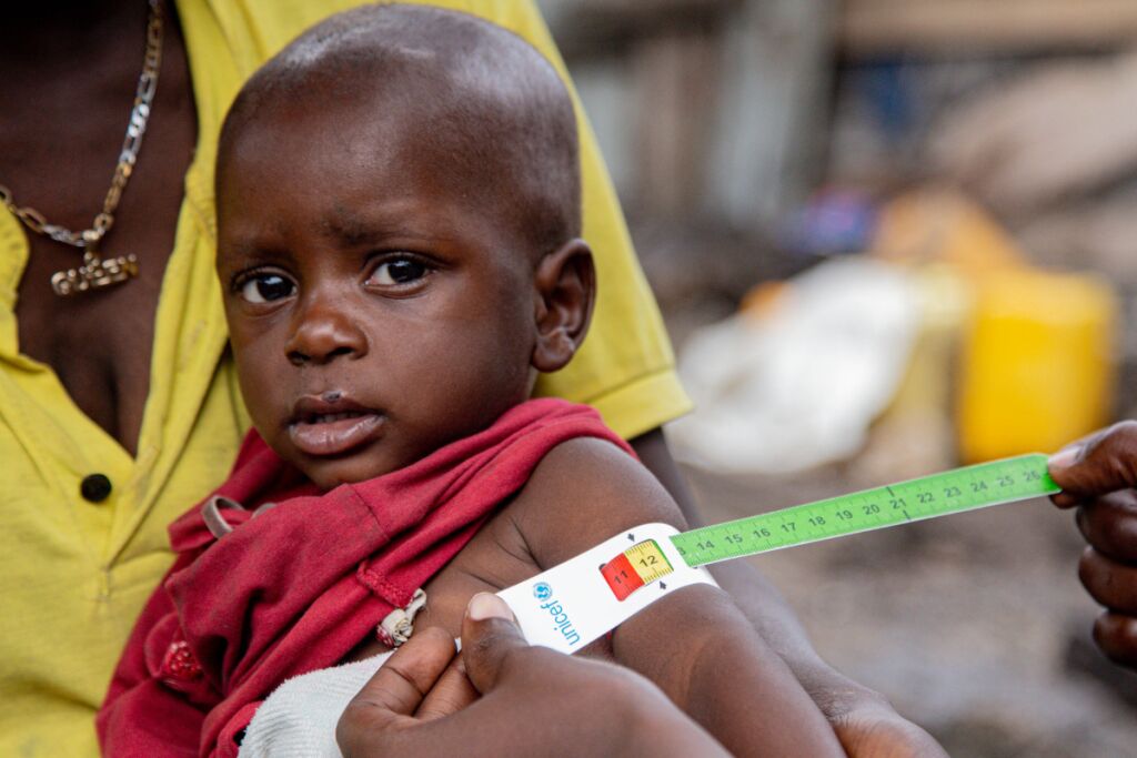 UNICEFin työntekjjä mittaa pienen lapsen käden ympärysmittaa, jolla tutkitaan aliravitsemusta.