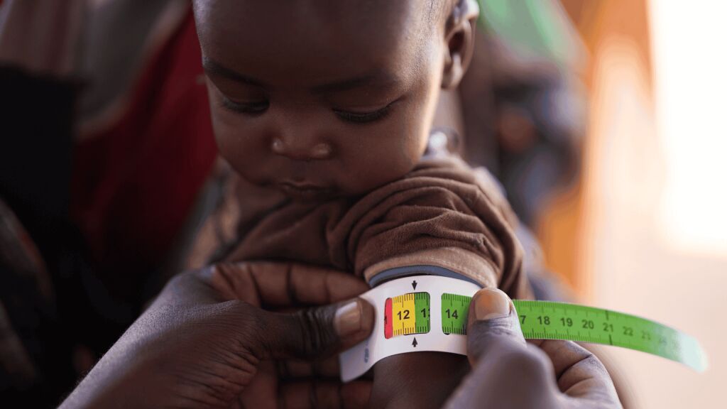 Pienen lapsen käsivarresta mitataan aliravitsemusta. 
